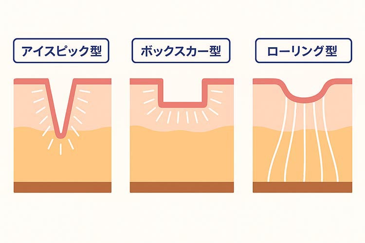 ニキビ跡の断面図(アイスピック型・ボックスカー型・ローリング型)