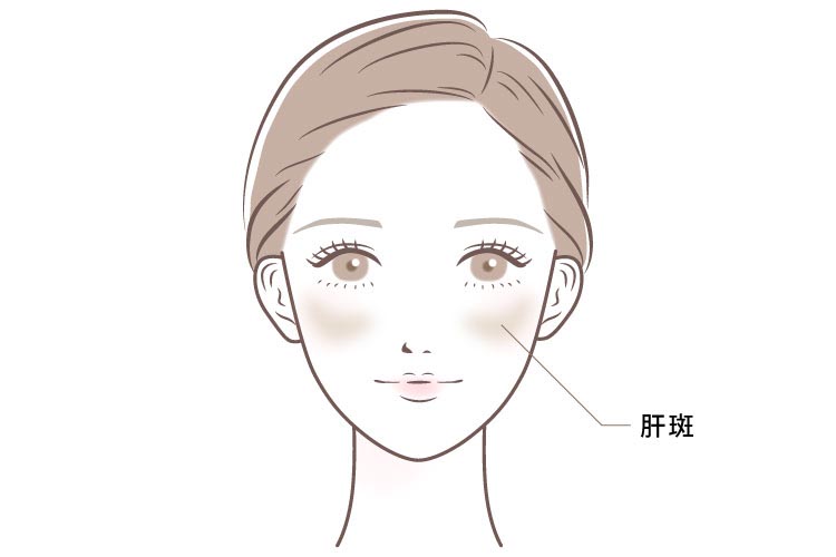 肝斑説明画像