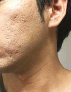 【結論】新宿でニキビ跡治療を受けるなら「診断の質」が重要