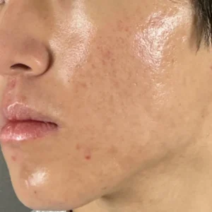 イソトレチノイン 症例写真 before/after