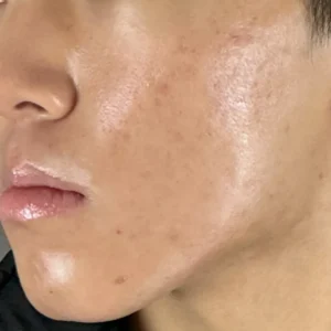 イソトレチノイン 症例写真 before/after