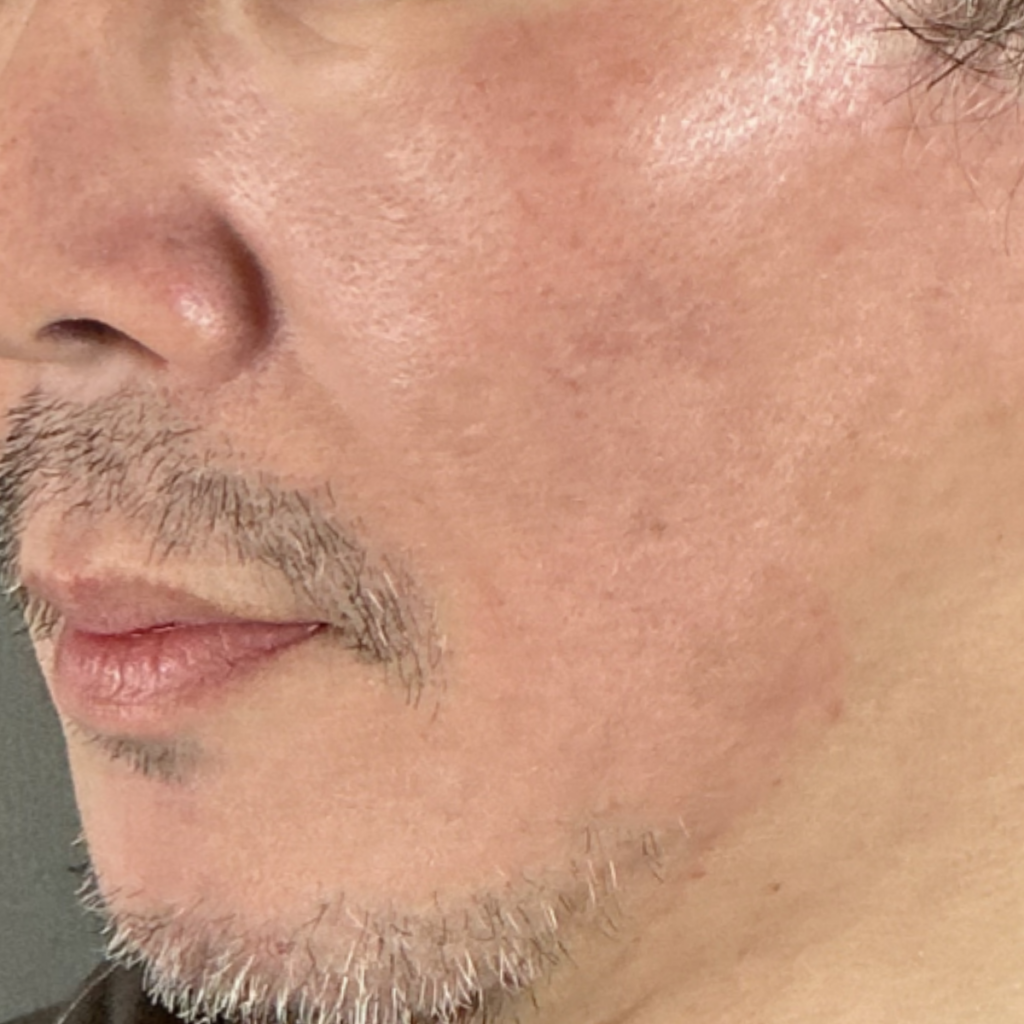 ステラM22 治療前