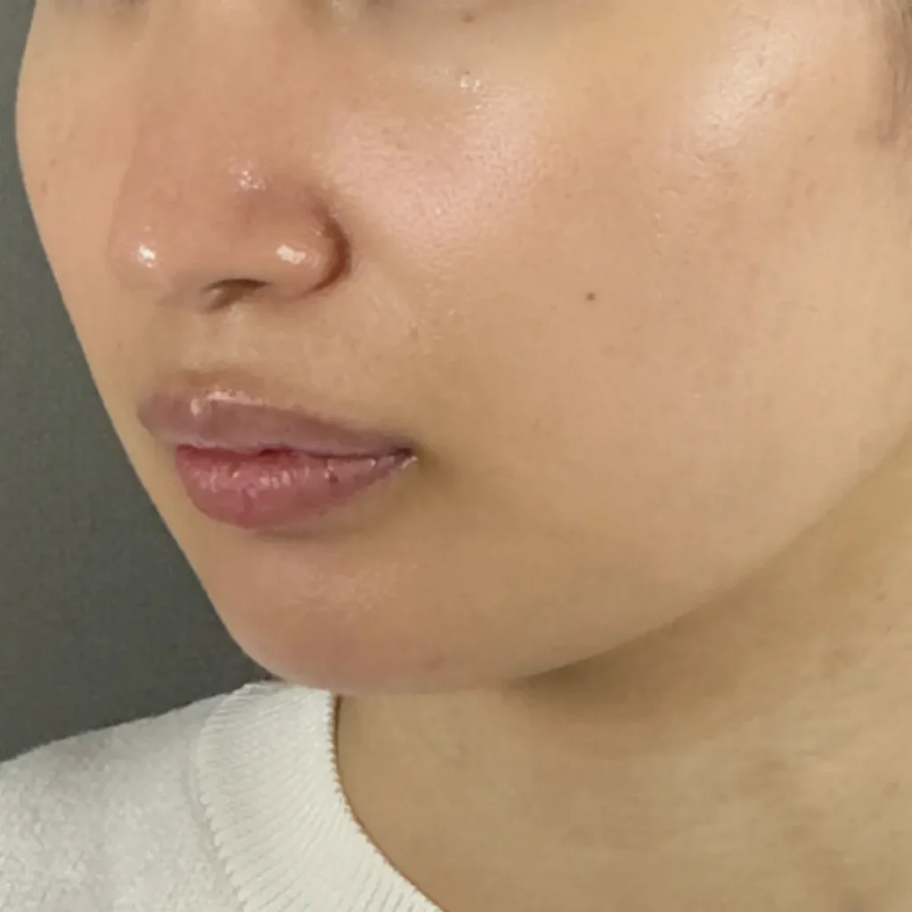 イソトレチノイン 症例写真after