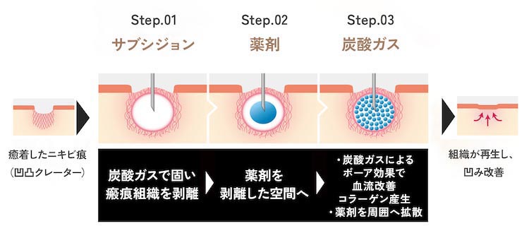 トライフィルプロの仕組み